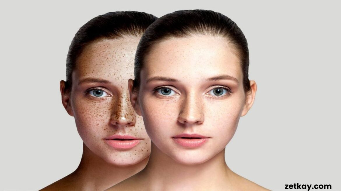 dark spots