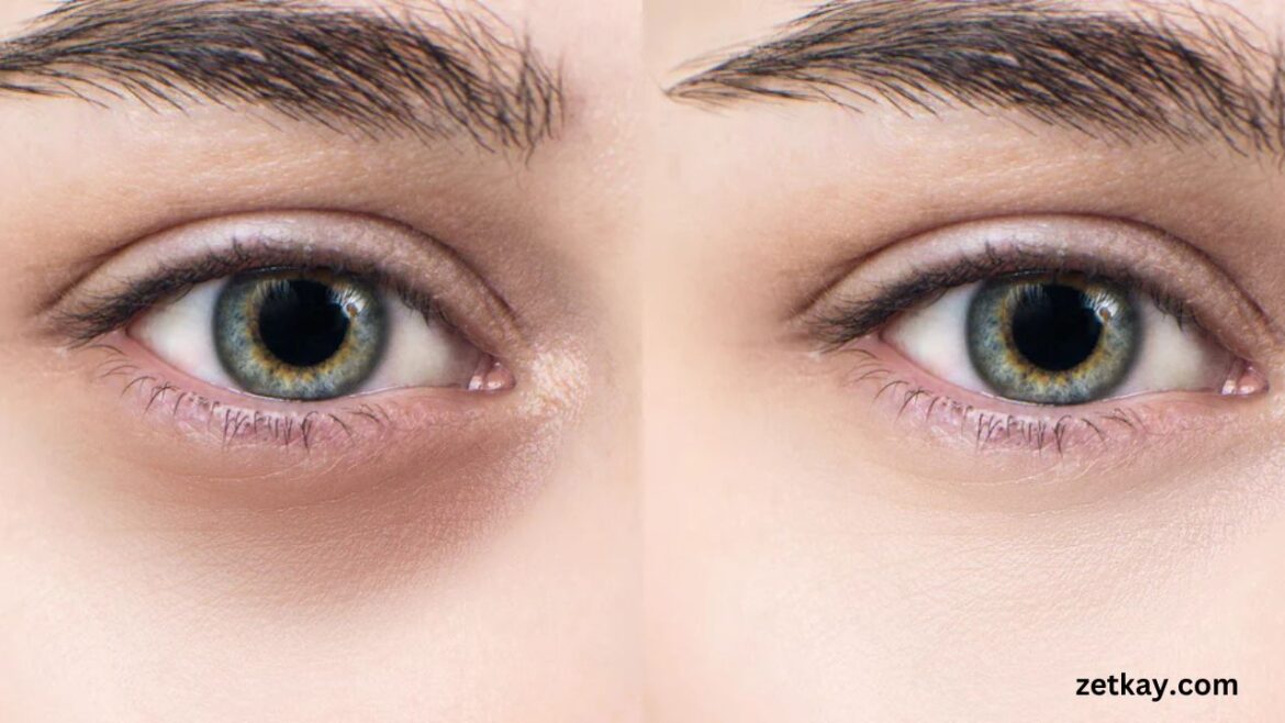 Dark Circles