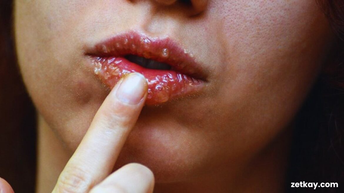 Cold Sores
